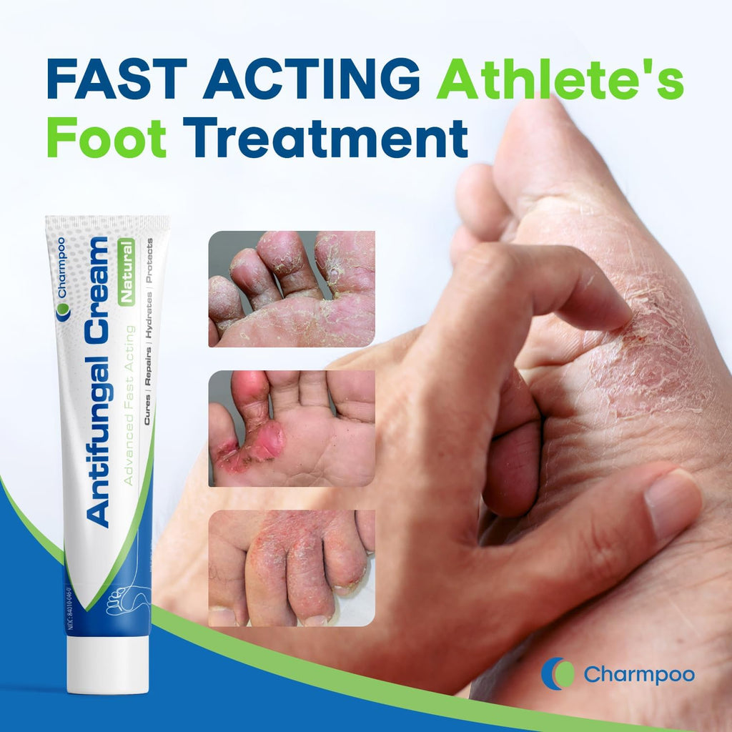 Antifungal Cream for Foot and Body: Fast Relief Athlete's Foot Jock Itch Psoriasis Ringworm Eczema Rashes - Powerful Herbal and Miconazole Formula 30g(Pack of 2)