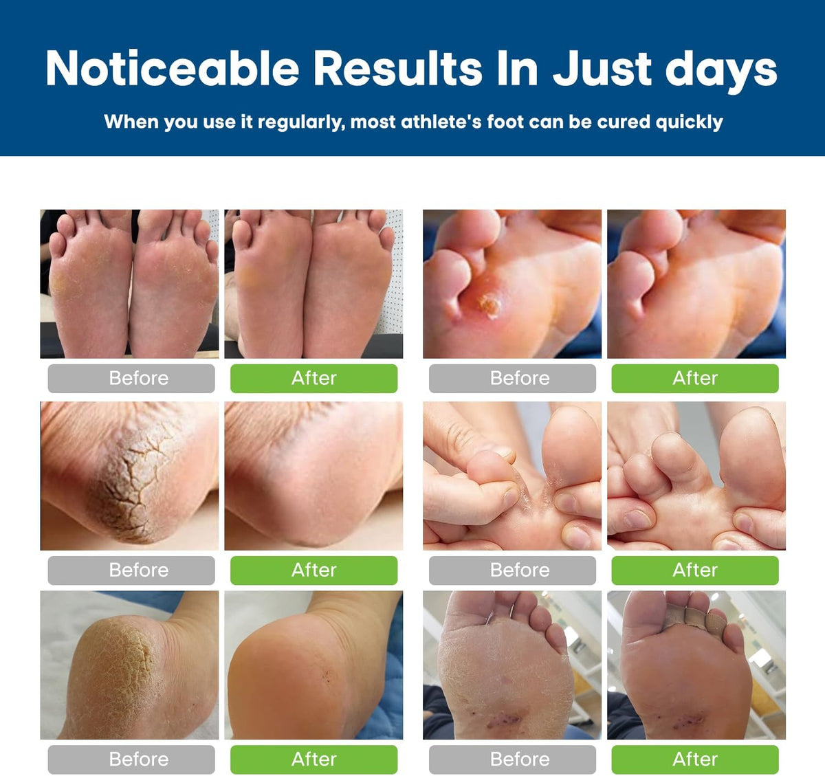 Antifungal Cream for Foot and Body: Fast Relief Athlete's Foot Jock Itch Psoriasis Ringworm Eczema Rashes - Powerful Herbal and Miconazole Formula 30g(Pack of 2)