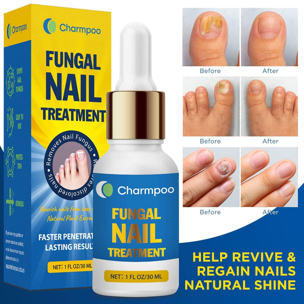 Toenail Fungus Treatment Extra Strength 30ml: Nail Cuticle Care Serum – Infused with Botanical Herbal Extracts for Clear Healthy-Looking Nails Lightweight Daily Nail & Toe Care