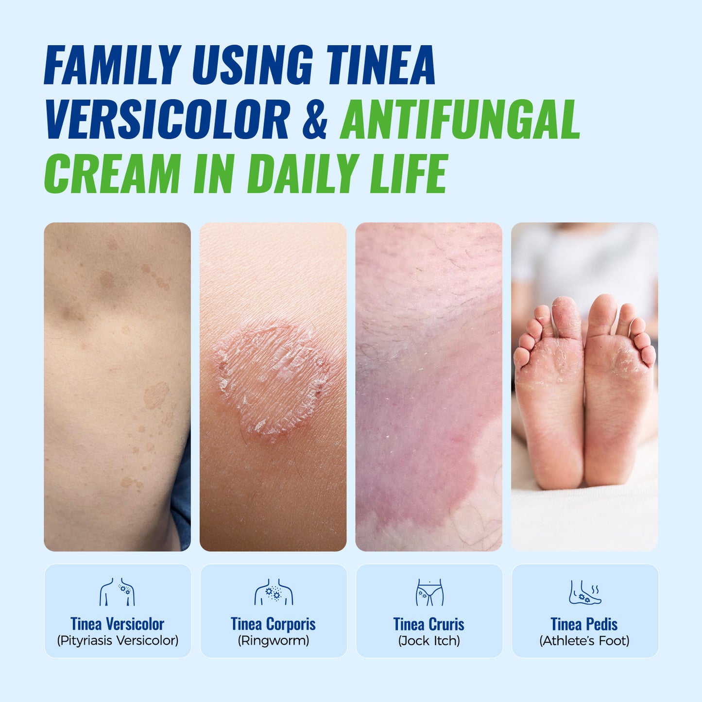 CHARMPOO Clotrimazole 1% Antifungal Cream for Tinea Versicolor, 3.53 oz